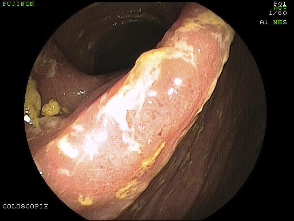 Endoskopija črevesja - Crohnova bolezen | Avtor: Profimedia
