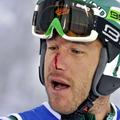 Bode Miller je v Leviju utrpel grd udarec kola v obraz. (Foto: Reuters)